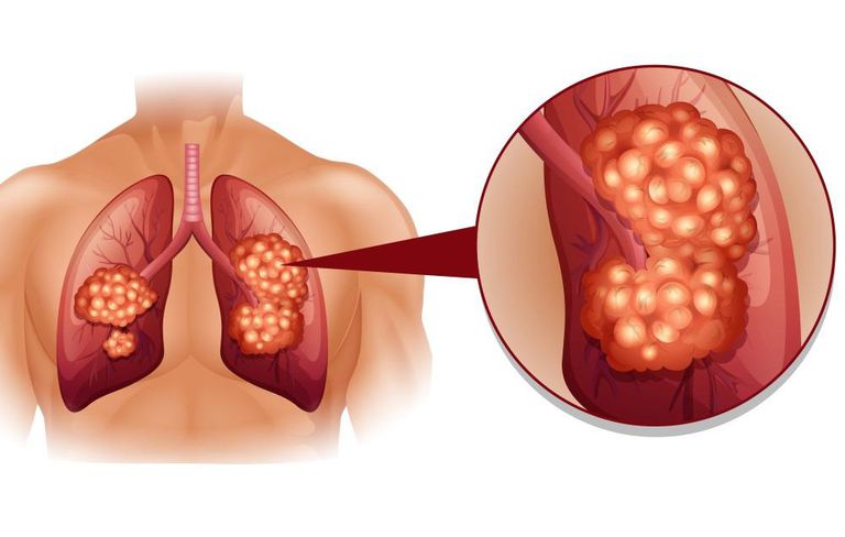 Ung thư phổi, gan di căn theo những con đường nào?