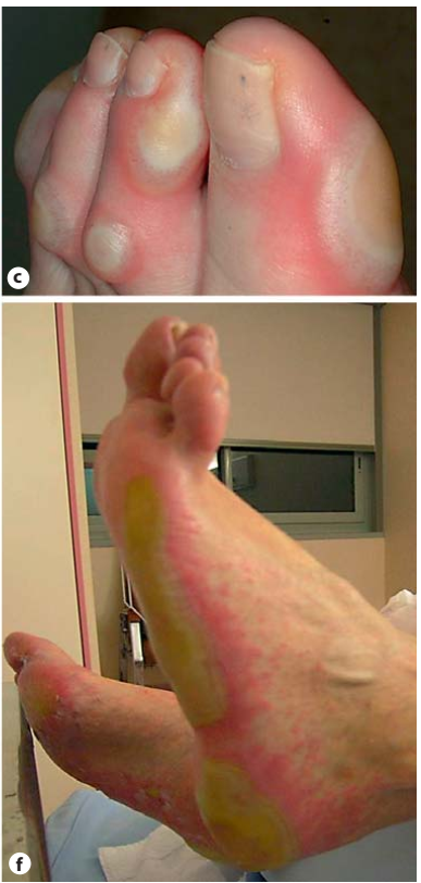 Hội chứng bàn tay bàn chân khi sử dụng thuốc điều trị ung thư- cách xử trí