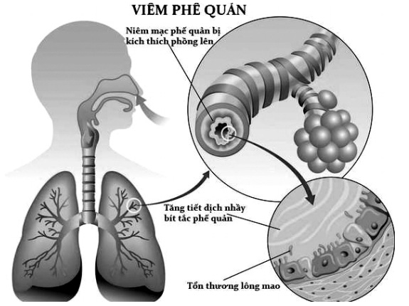 Viêm phế quản cấp tính?  Nguyên nhân, triệu chứng và phương pháp điều trị