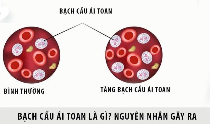 Tăng bạch cầu ái toan và phương pháp điều trị