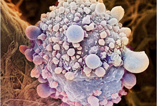 Những điều cần biết về hội chứng ly giải khối u